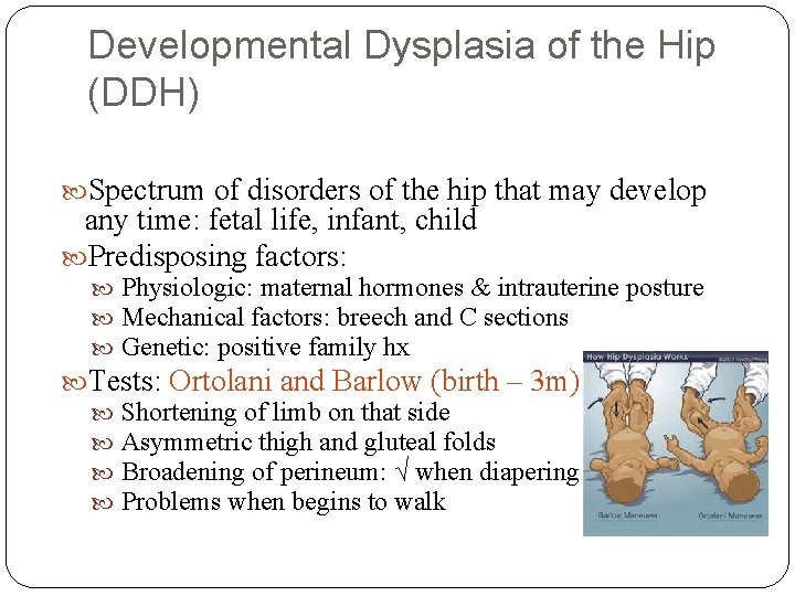 Developmental Dysplasia of the Hip (DDH) Spectrum of disorders of the hip that may