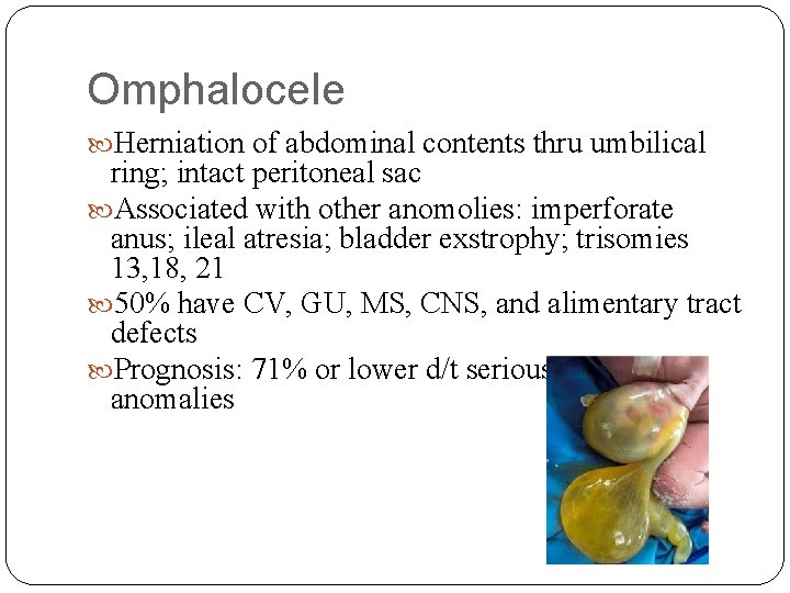 Omphalocele Herniation of abdominal contents thru umbilical ring; intact peritoneal sac Associated with other