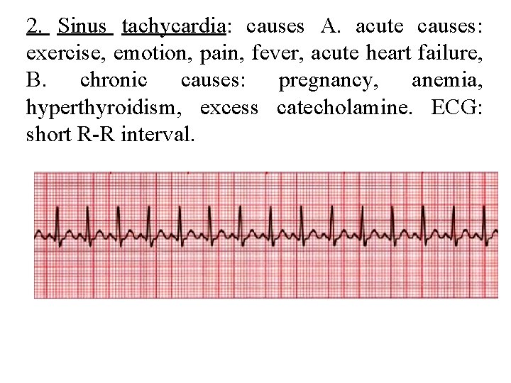 2. Sinus tachycardia: causes A. acute causes: exercise, emotion, pain, fever, acute heart failure,