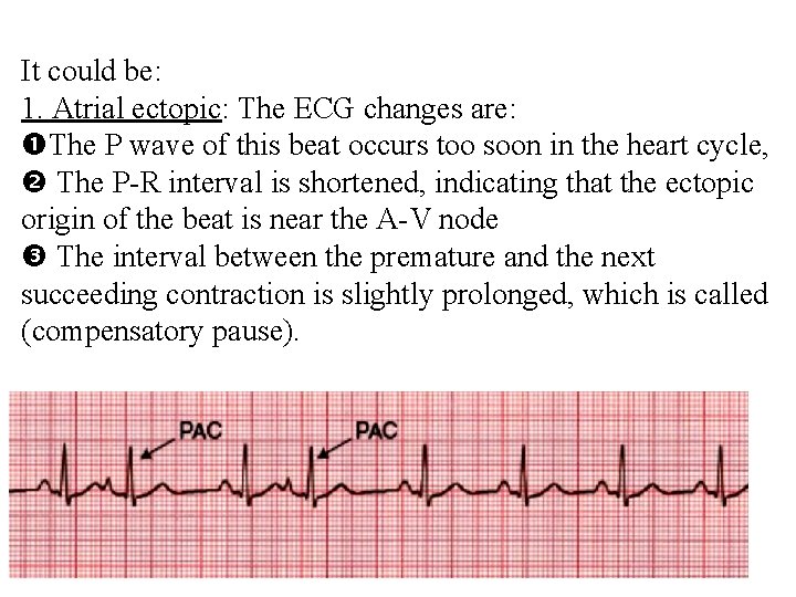 It could be: 1. Atrial ectopic: The ECG changes are: The P wave of