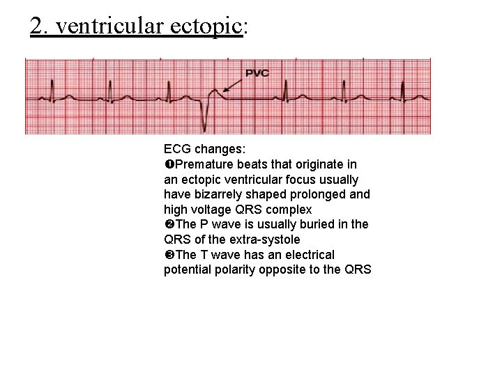 2. ventricular ectopic: ECG changes: Premature beats that originate in an ectopic ventricular focus