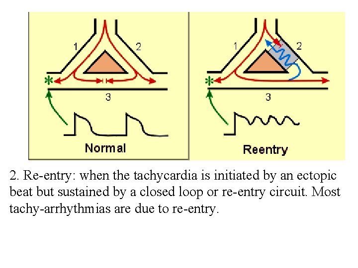 2. Re entry: when the tachycardia is initiated by an ectopic beat but sustained