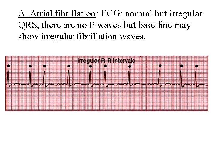 A. Atrial fibrillation: ECG: normal but irregular QRS, there are no P waves but