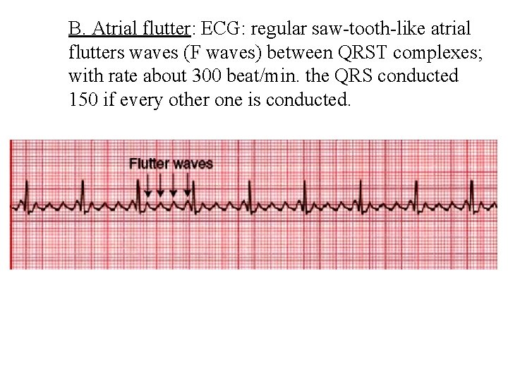 B. Atrial flutter: ECG: regular saw tooth like atrial flutters waves (F waves) between