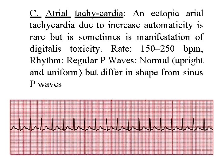 C. Atrial tachy cardia: An ectopic arial tachycardia due to increase automaticity is rare