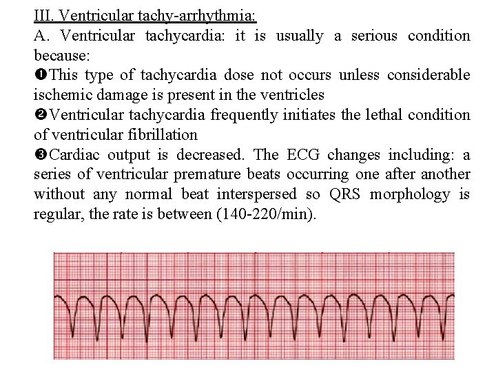 III. Ventricular tachy arrhythmia: A. Ventricular tachycardia: it is usually a serious condition because: