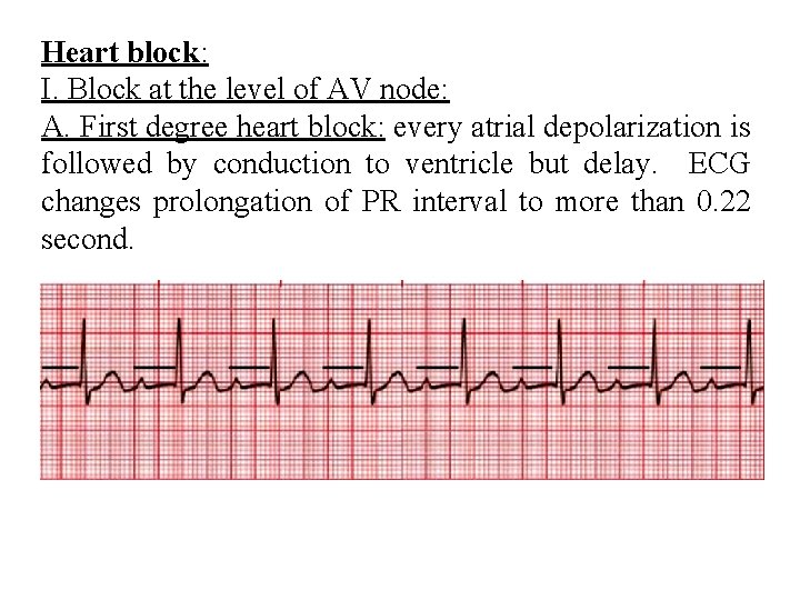 Heart block: I. Block at the level of AV node: A. First degree heart
