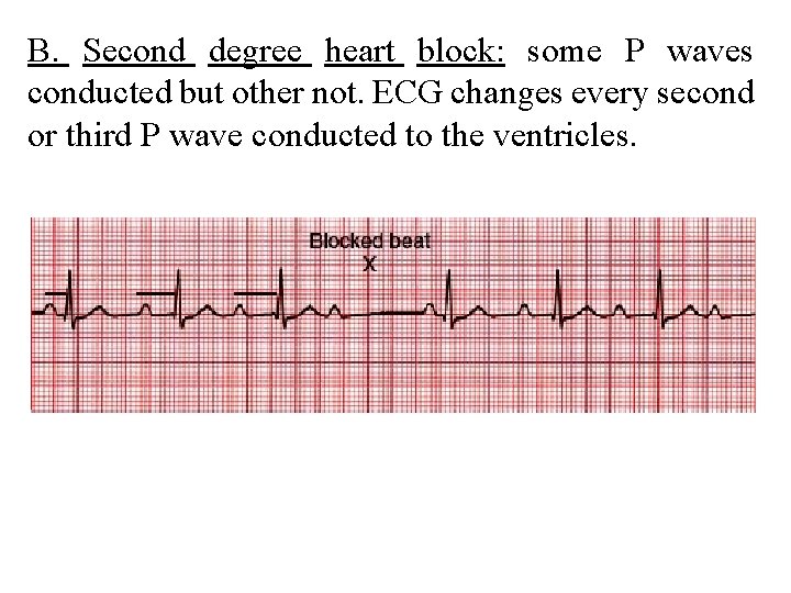 B. Second degree heart block: some P waves conducted but other not. ECG changes