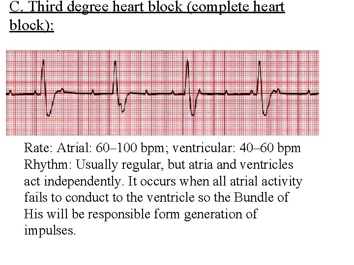 C. Third degree heart block (complete heart block): Rate: Atrial: 60– 100 bpm; ventricular: