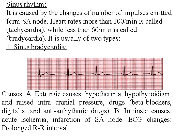 Sinus rhythm: It is caused by the changes of number of impulses emitted form