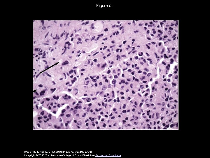 Figure 5. CHEST 2010 1381247 -1252 DOI: (10. 1378/chest. 09 -2439) Copyright © 2010