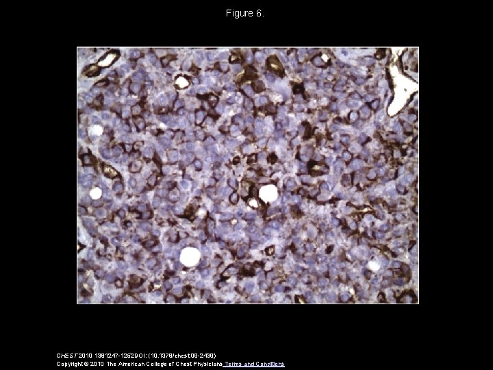 Figure 6. CHEST 2010 1381247 -1252 DOI: (10. 1378/chest. 09 -2439) Copyright © 2010