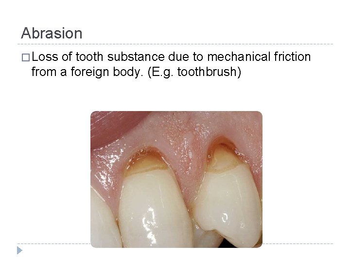 Abrasion � Loss of tooth substance due to mechanical friction from a foreign body.