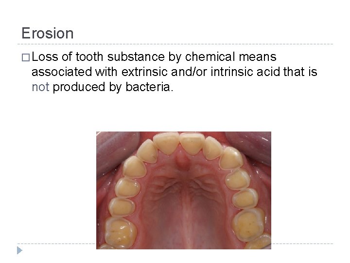 Erosion � Loss of tooth substance by chemical means associated with extrinsic and/or intrinsic