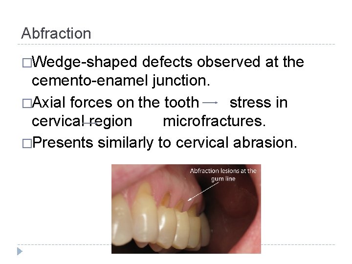 Abfraction �Wedge-shaped defects observed at the cemento-enamel junction. �Axial forces on the tooth stress