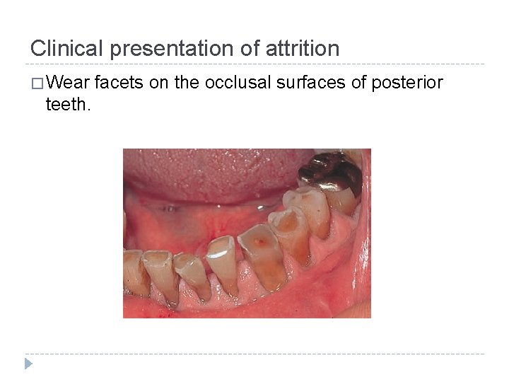 Clinical presentation of attrition � Wear teeth. facets on the occlusal surfaces of posterior