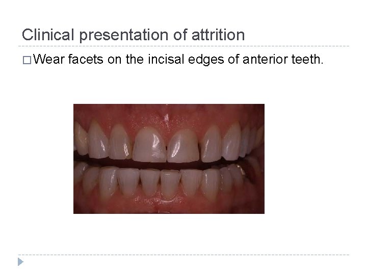 Clinical presentation of attrition � Wear facets on the incisal edges of anterior teeth.