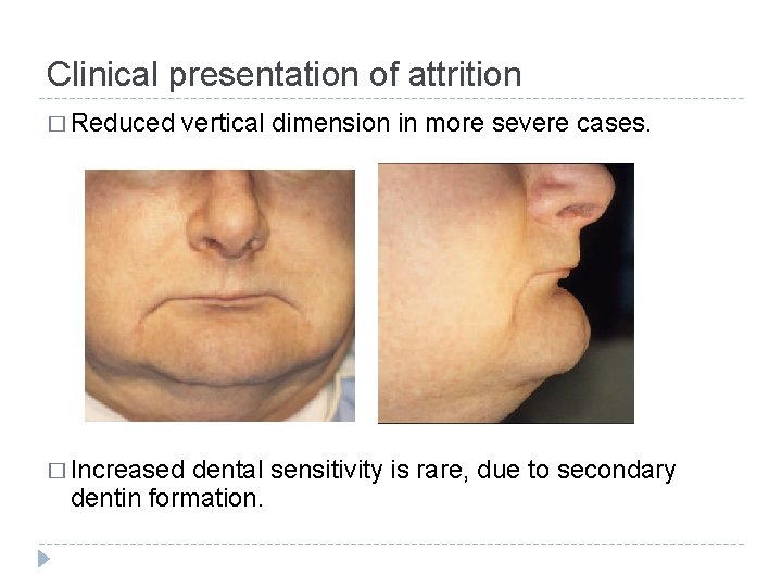 Clinical presentation of attrition � Reduced vertical dimension in more severe cases. � Increased