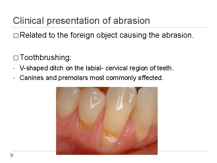 Clinical presentation of abrasion � Related to the foreign object causing the abrasion. �