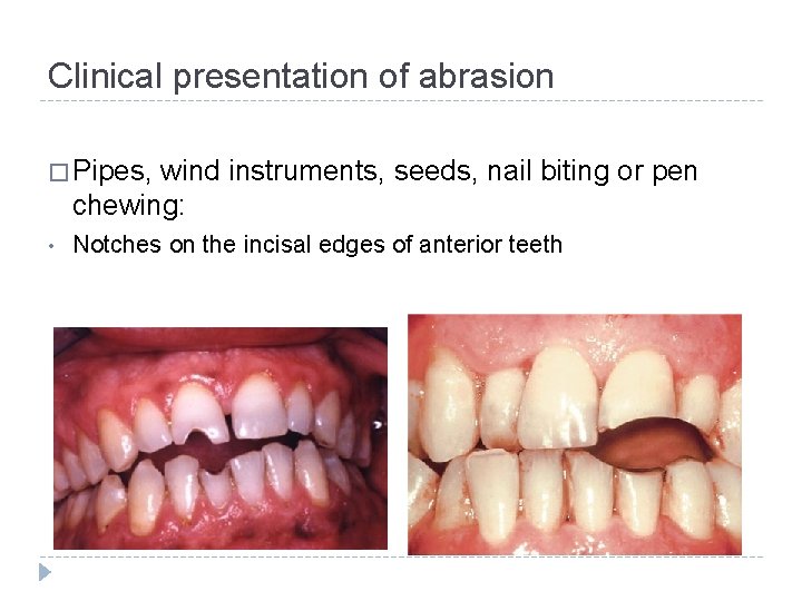 Clinical presentation of abrasion � Pipes, wind instruments, seeds, nail biting or pen chewing: