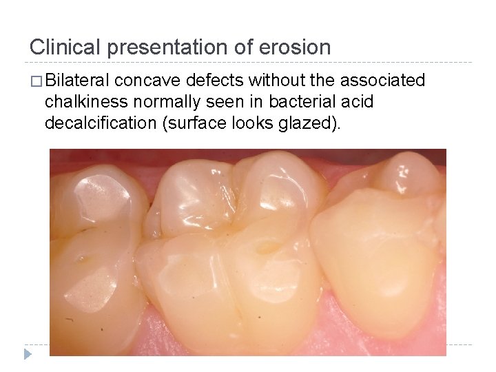 Clinical presentation of erosion � Bilateral concave defects without the associated chalkiness normally seen