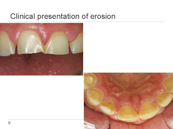 Clinical presentation of erosion 