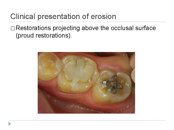 Clinical presentation of erosion � Restorations projecting above the occlusal surface (proud restorations). 