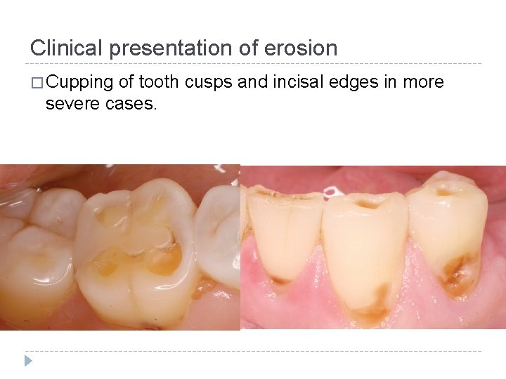 Clinical presentation of erosion � Cupping of tooth cusps and incisal edges in more