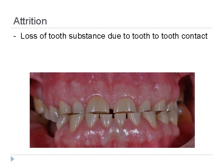 Attrition - Loss of tooth substance due to tooth contact 