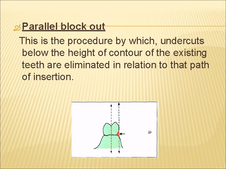  Parallel block out This is the procedure by which, undercuts below the height