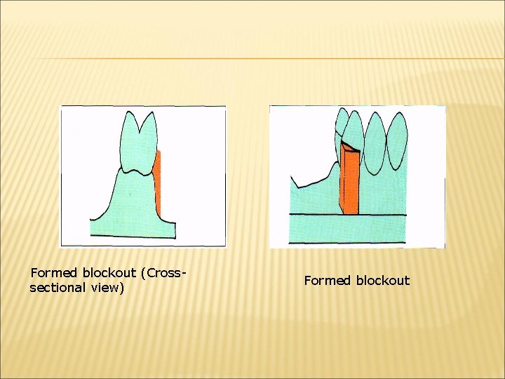 Formed blockout (Crosssectional view) Formed blockout 