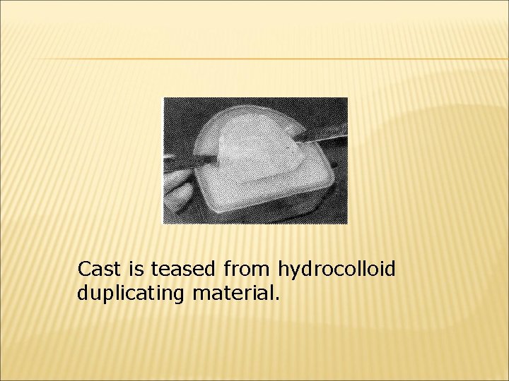 Cast is teased from hydrocolloid duplicating material. 