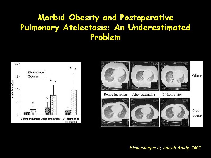 Morbid Obesity and Postoperative Pulmonary Atelectasis: An Underestimated Problem Eichenberger A; Anesth Analg. 2002