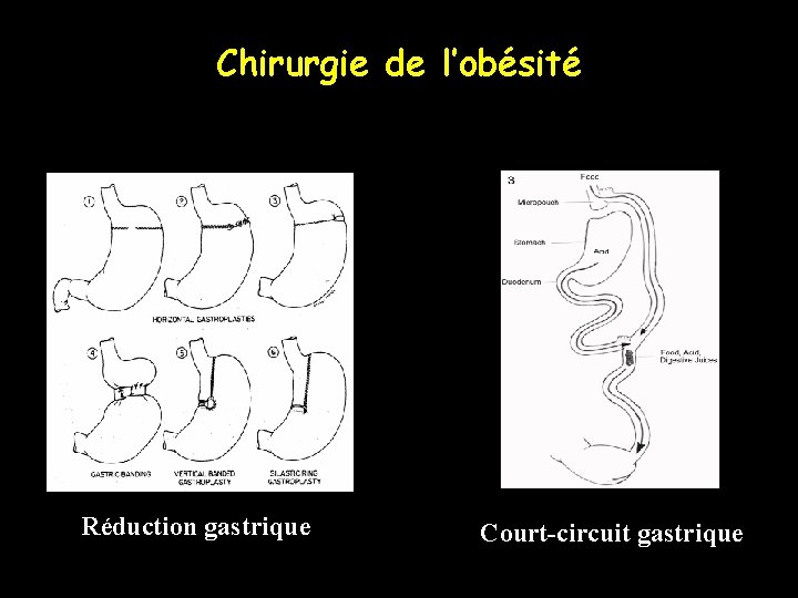 Chirurgie de l’obésité Réduction gastrique Court-circuit gastrique 