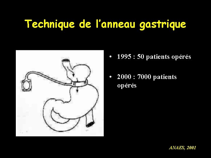 Technique de l’anneau gastrique • 1995 : 50 patients opérés • 2000 : 7000