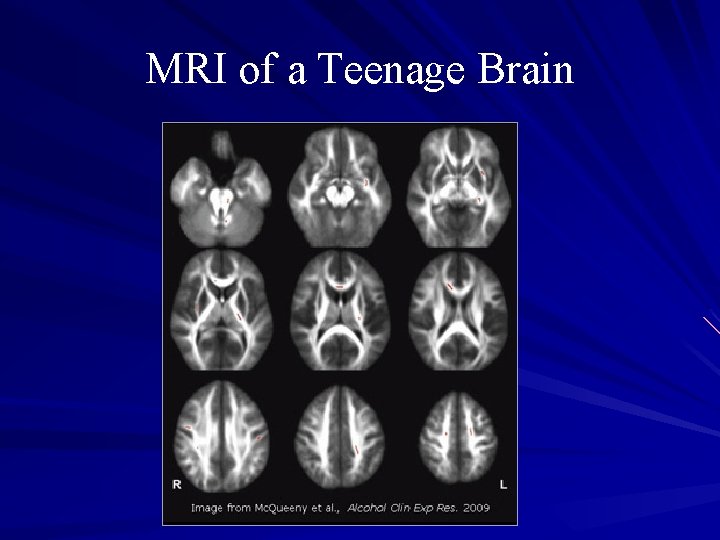 MRI of a Teenage Brain 