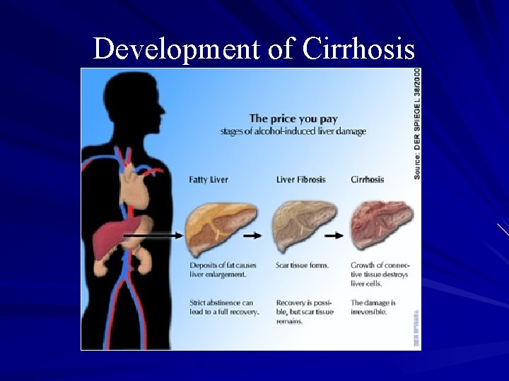 Development of Cirrhosis 