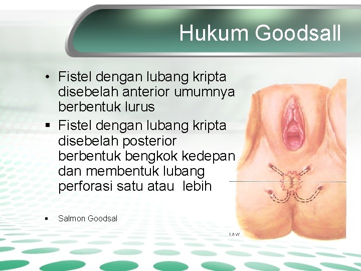 Hukum Goodsall • Fistel dengan lubang kripta disebelah anterior umumnya berbentuk lurus § Fistel