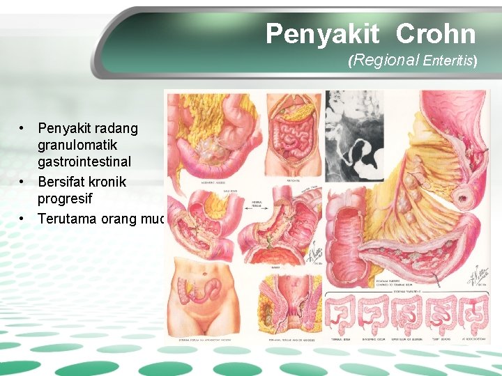 Penyakit Crohn (Regional Enteritis) • Penyakit radang granulomatik gastrointestinal • Bersifat kronik progresif •