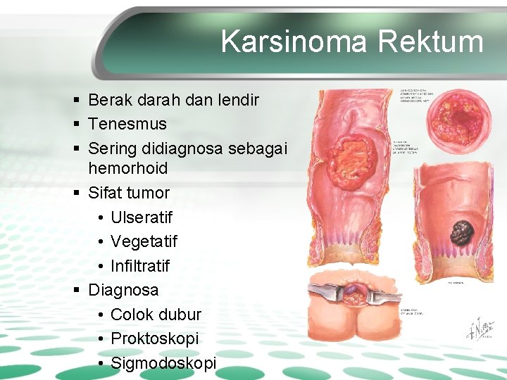 Karsinoma Rektum § Berak darah dan lendir § Tenesmus § Sering didiagnosa sebagai hemorhoid