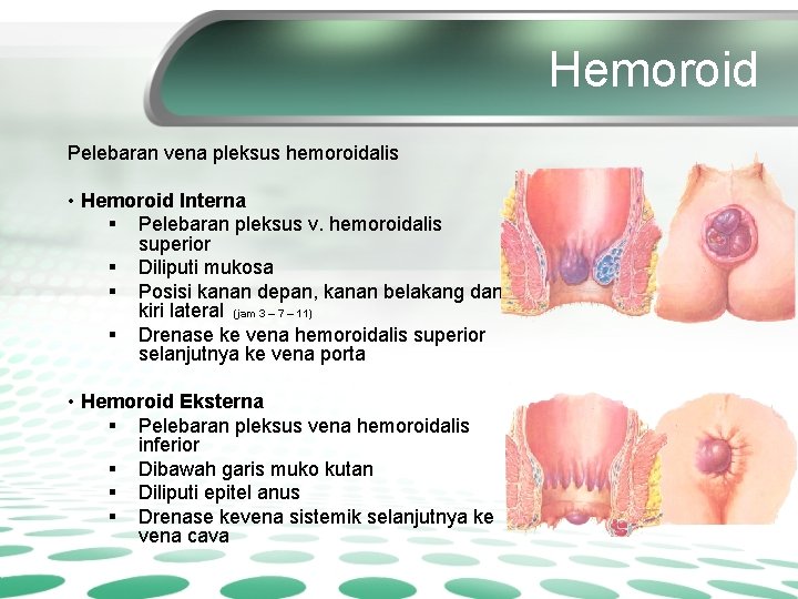 Hemoroid Pelebaran vena pleksus hemoroidalis • Hemoroid Interna § Pelebaran pleksus v. hemoroidalis superior