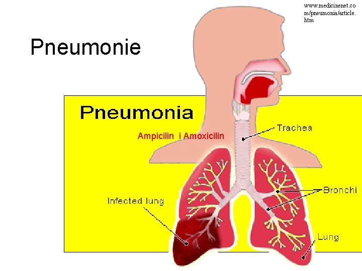 www. medicinenet. co m/pneumonia/article. htm Pneumonie Ampicilin i Amoxicilin 