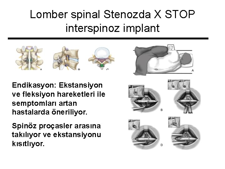 Lomber spinal Stenozda X STOP interspinoz implant Endikasyon: Ekstansiyon ve fleksiyon hareketleri ile semptomları