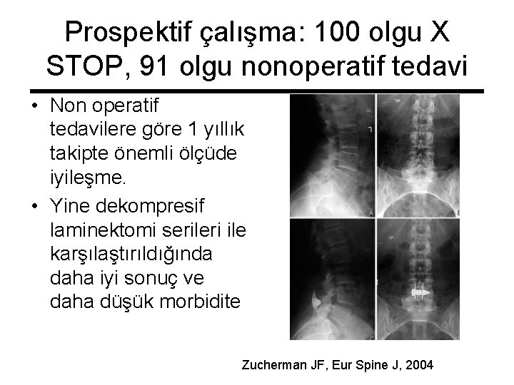 Prospektif çalışma: 100 olgu X STOP, 91 olgu nonoperatif tedavi • Non operatif tedavilere