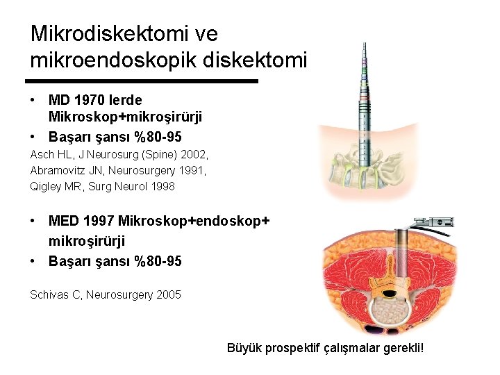 Mikrodiskektomi ve mikroendoskopik diskektomi • MD 1970 lerde Mikroskop+mikroşirürji • Başarı şansı %80 -95