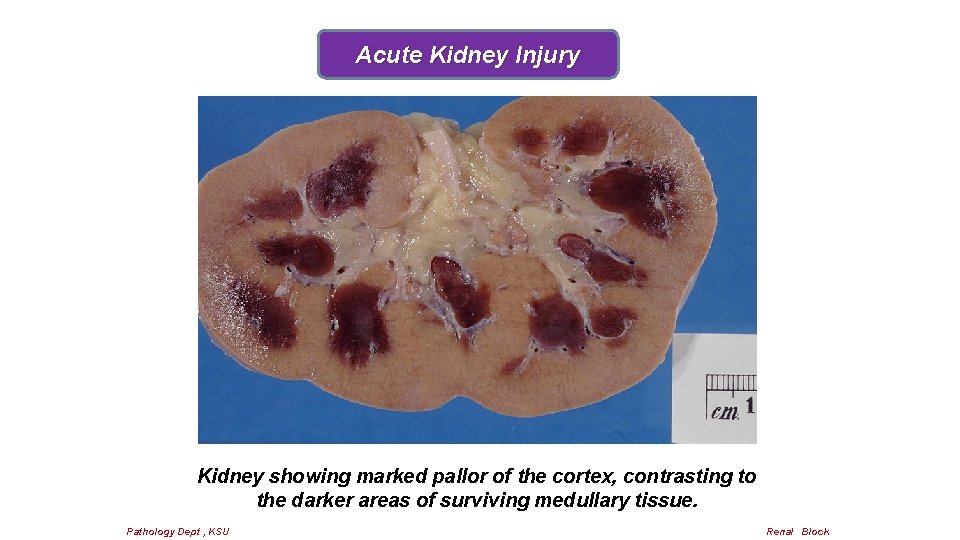 Acute Kidney Injury Kidney showing marked pallor of the cortex, contrasting to the darker