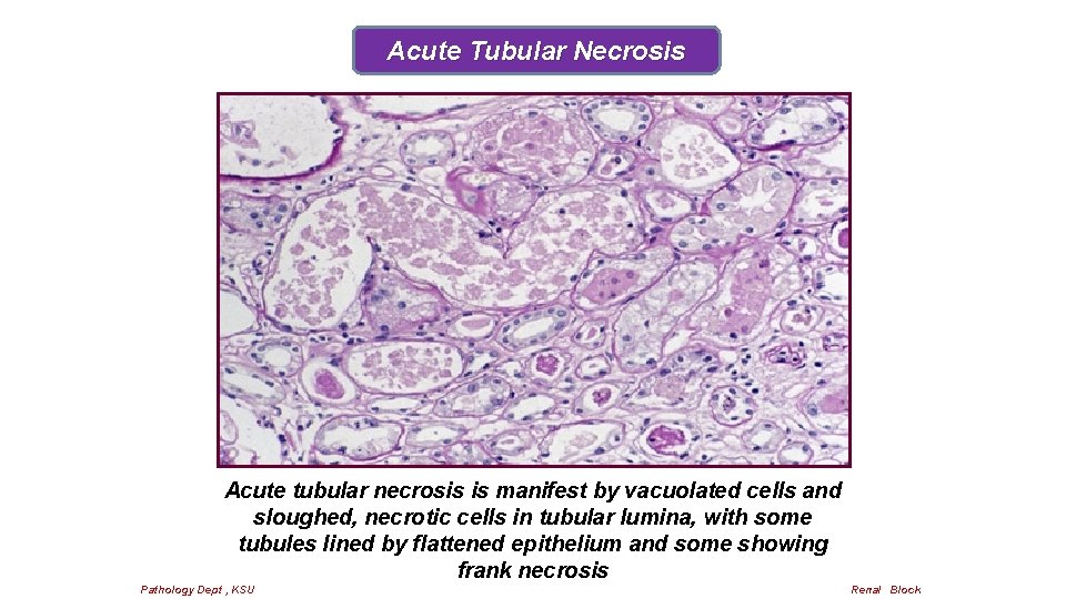 Acute Tubular Necrosis Acute tubular necrosis is manifest by vacuolated cells and sloughed, necrotic