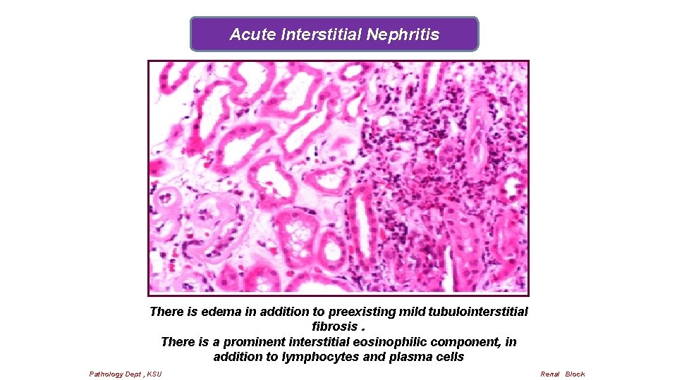 Acute Interstitial Nephritis There is edema in addition to preexisting mild tubulointerstitial fibrosis. There