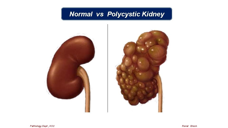 Normal vs Polycystic Kidney Pathology Dept , KSU Renal Block 