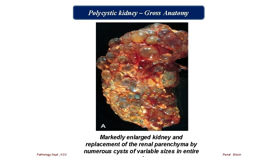 Polycystic kidney – Gross Anatomy Pathology Dept , KSU Markedly enlarged kidney and replacement